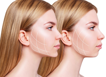 Çene - Jawline Dolgusu